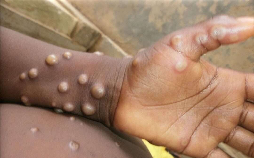 URGENTE: Confirmado primeiro caso de Mpox (varíola dos macacos) em Dakar