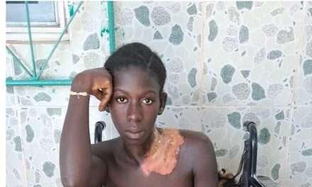 Jovem de 21 anos Sofre Queimaduras por Água Quente em Ingoré