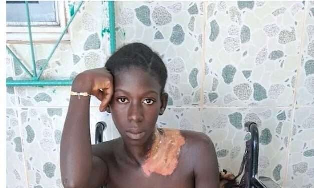 Jovem de 21 anos Sofre Queimaduras por Água Quente em Ingoré