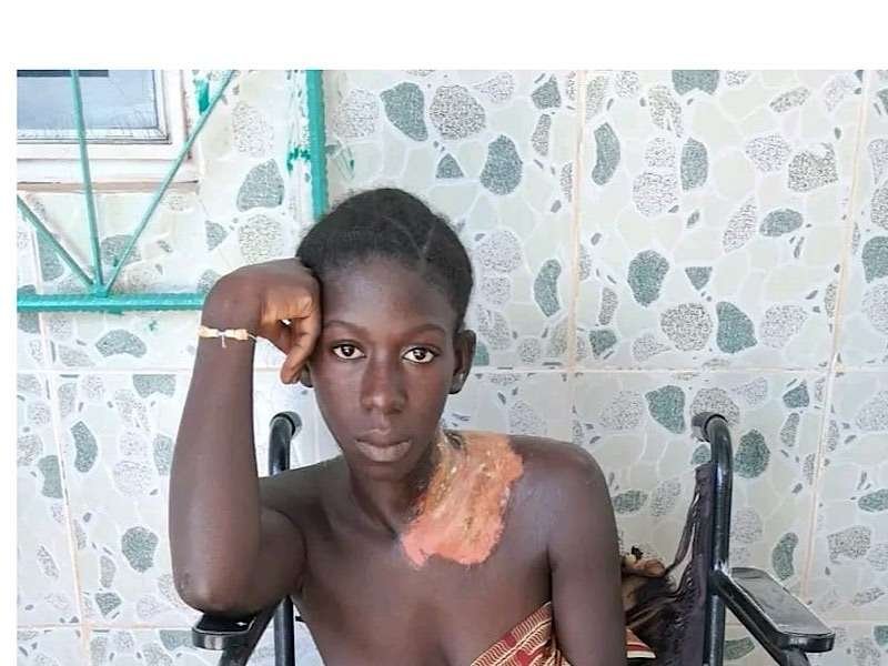 Jovem de 21 anos Sofre Queimaduras por Água Quente em Ingoré